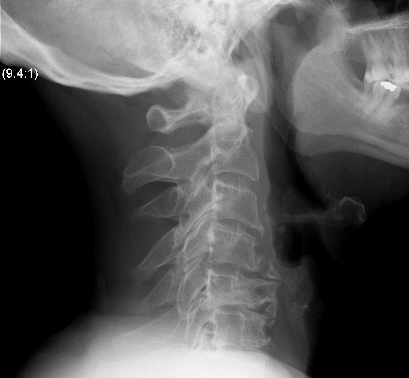 Lordotic Cervical Spine